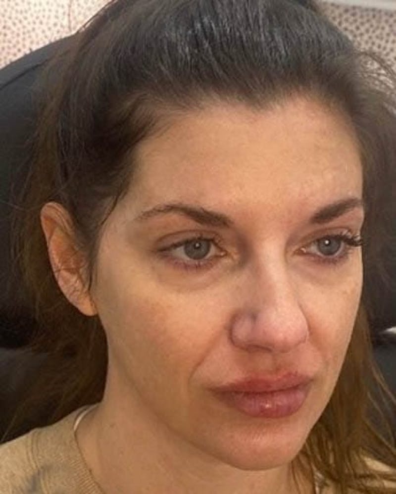 Before - Woman