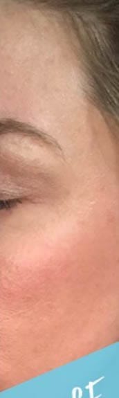Before and After