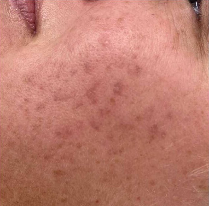 Acne