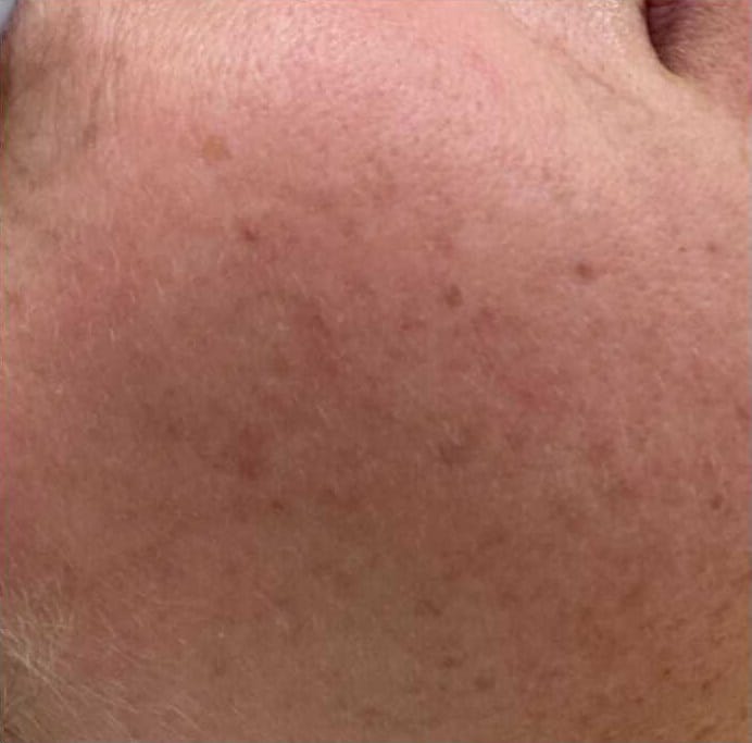 Acne