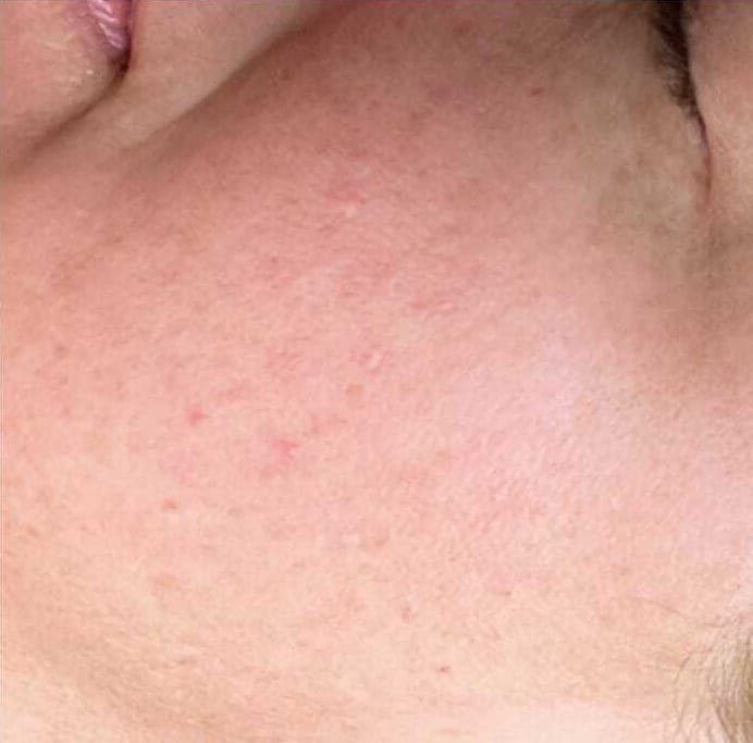 Acne