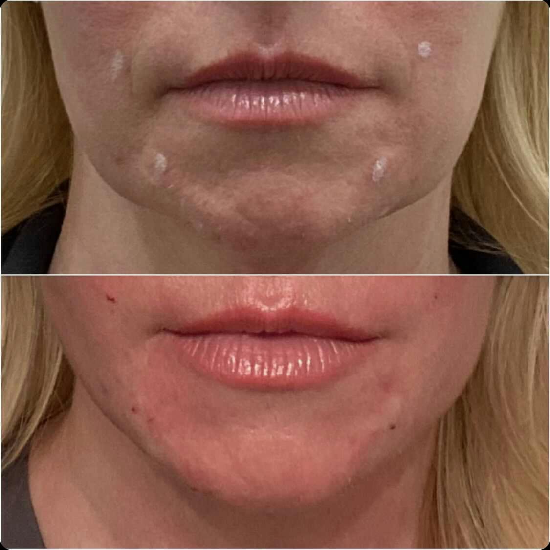 thread lift results