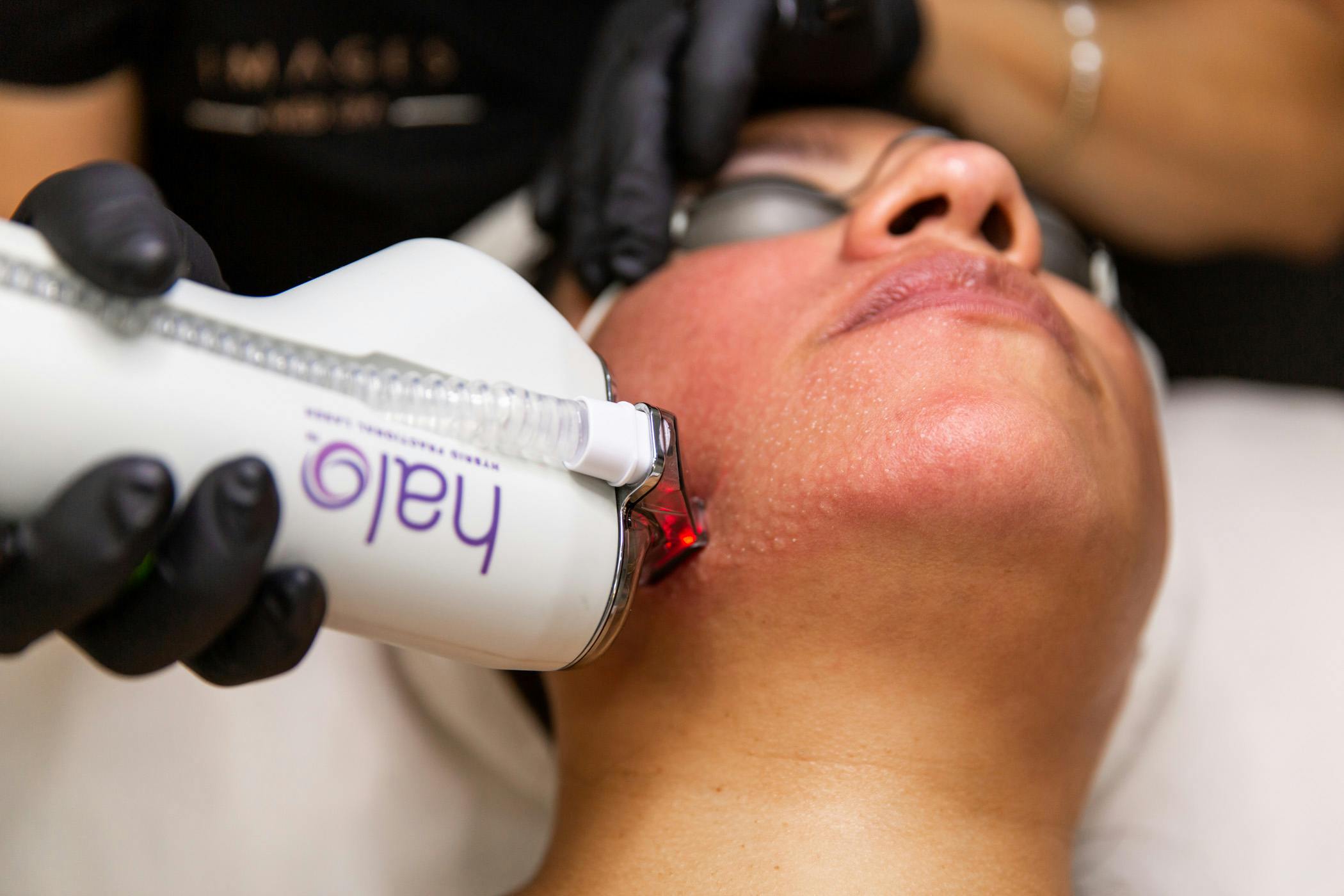 woman getting halo procedures