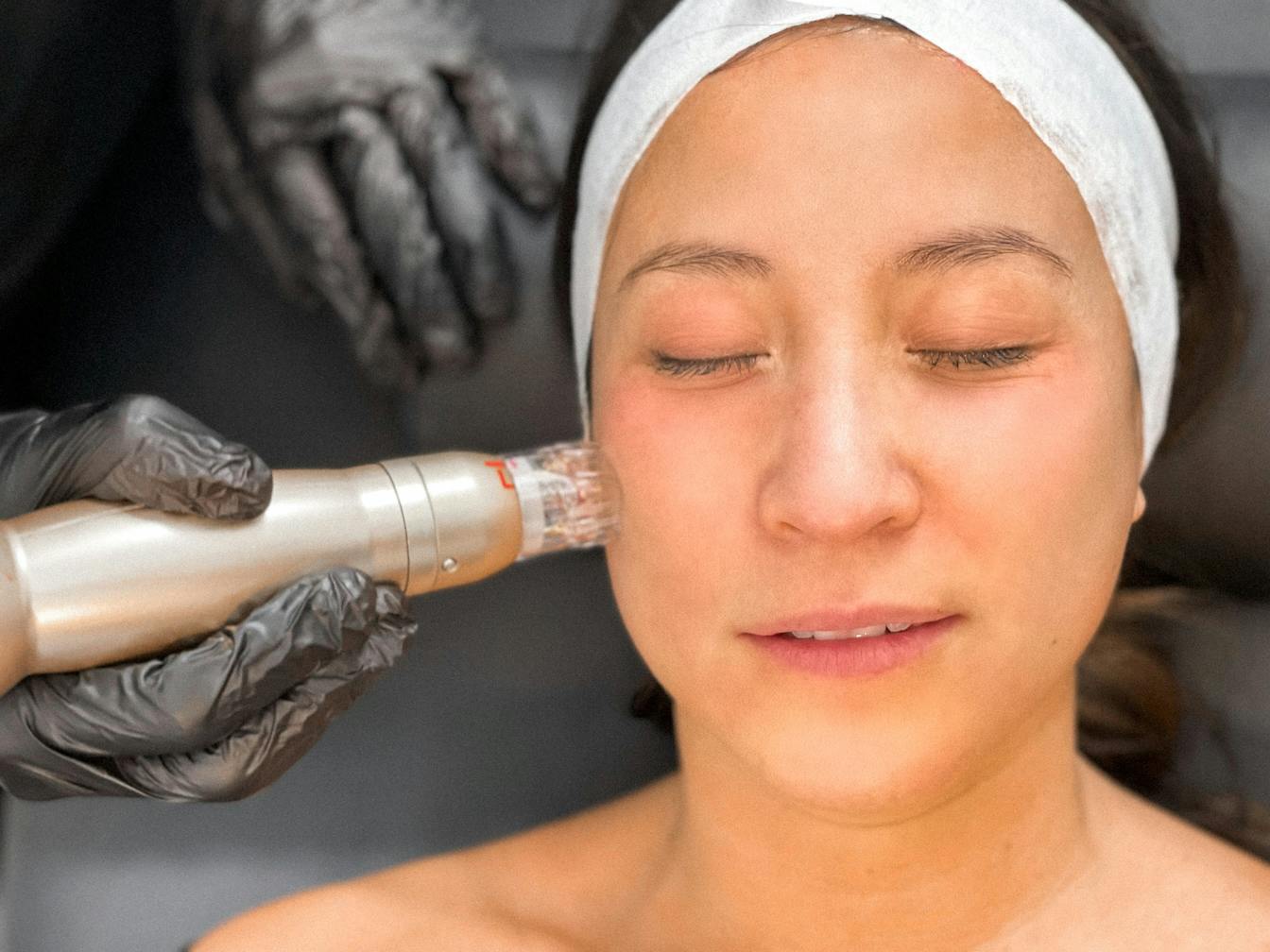 woman getting rf microneedling procedure done