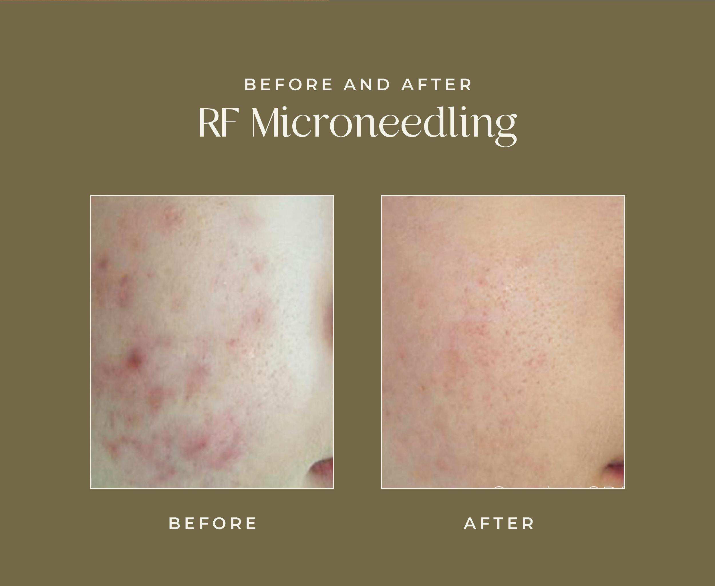 microneedling results