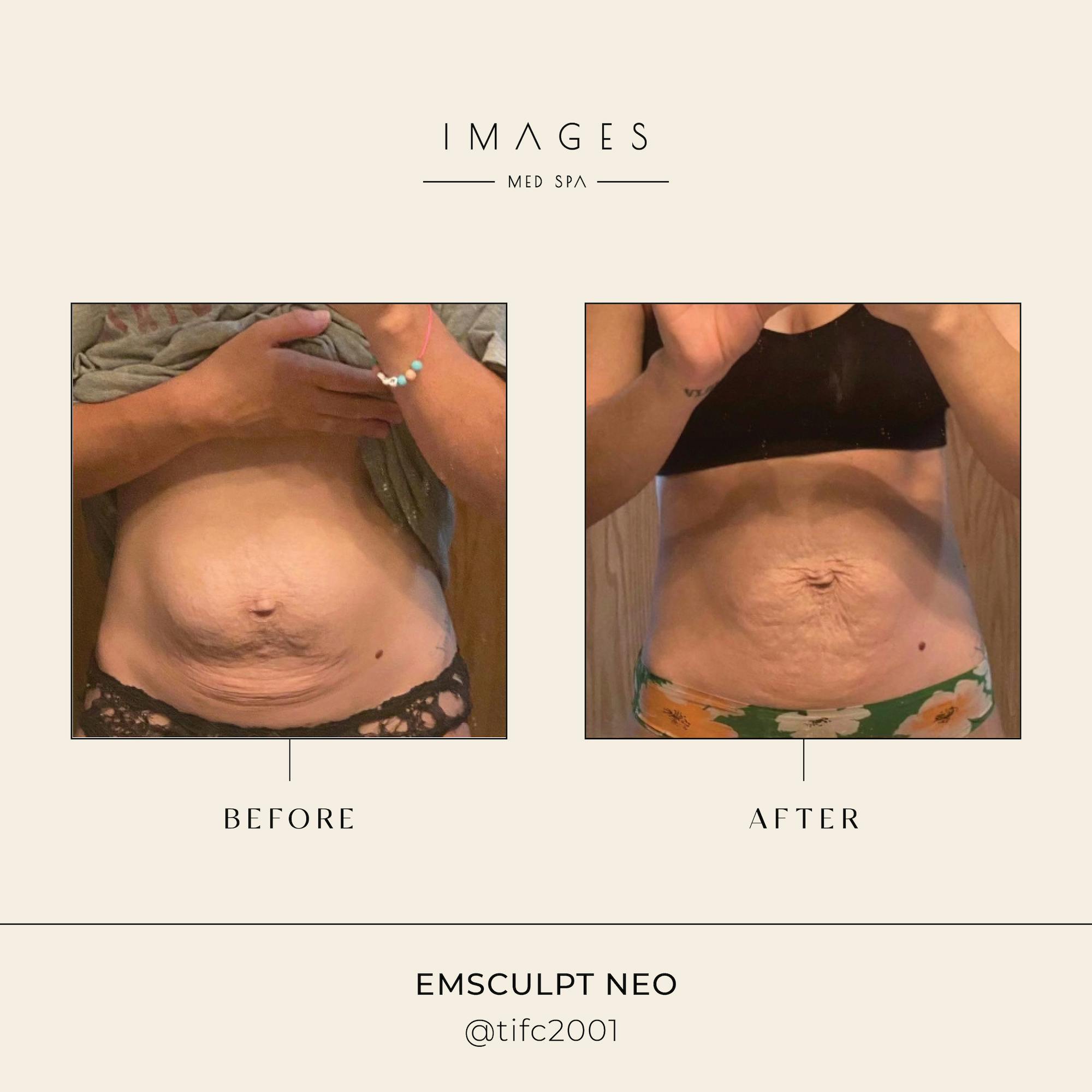EmSculpt results