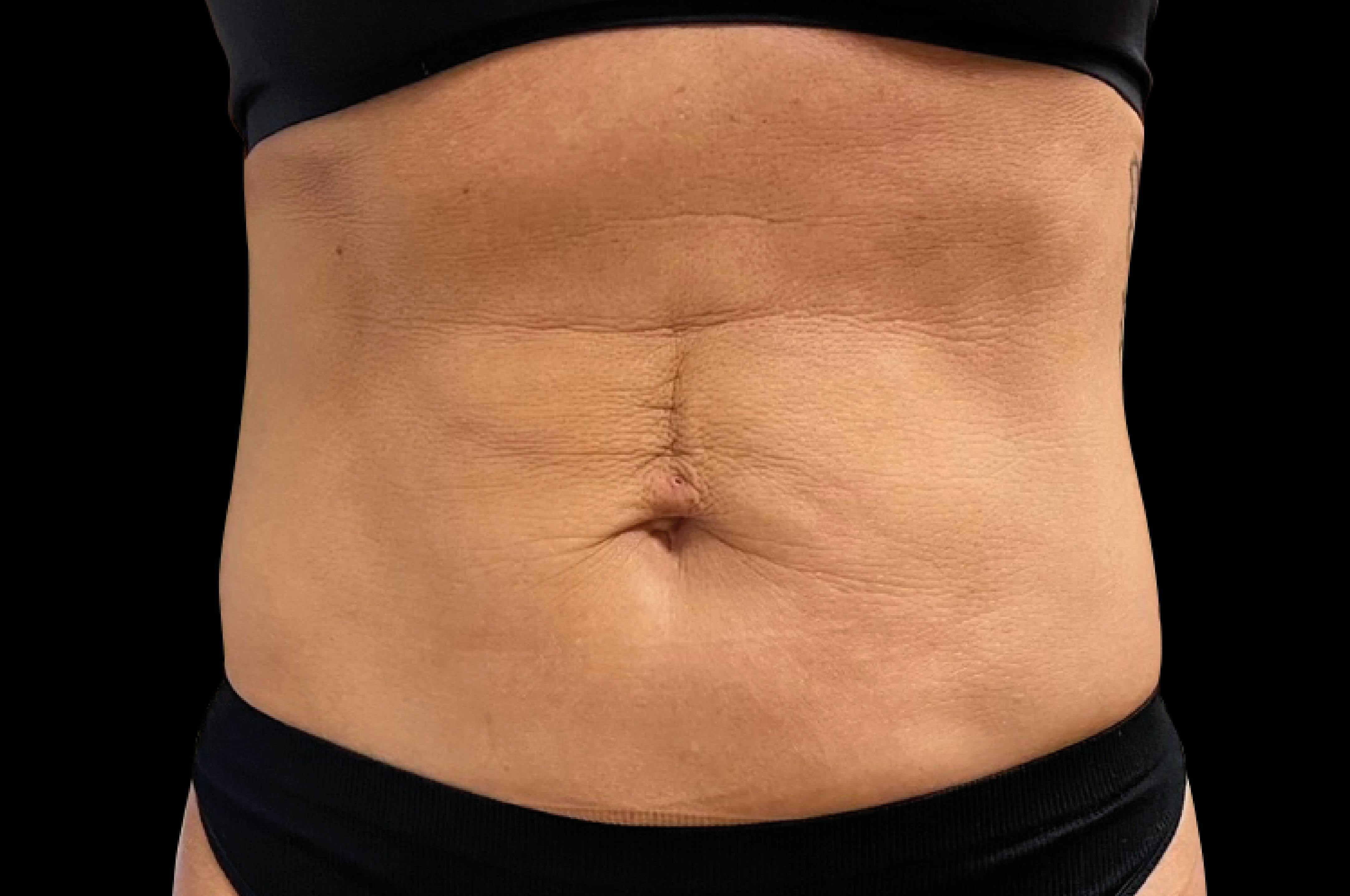 before emsculpt