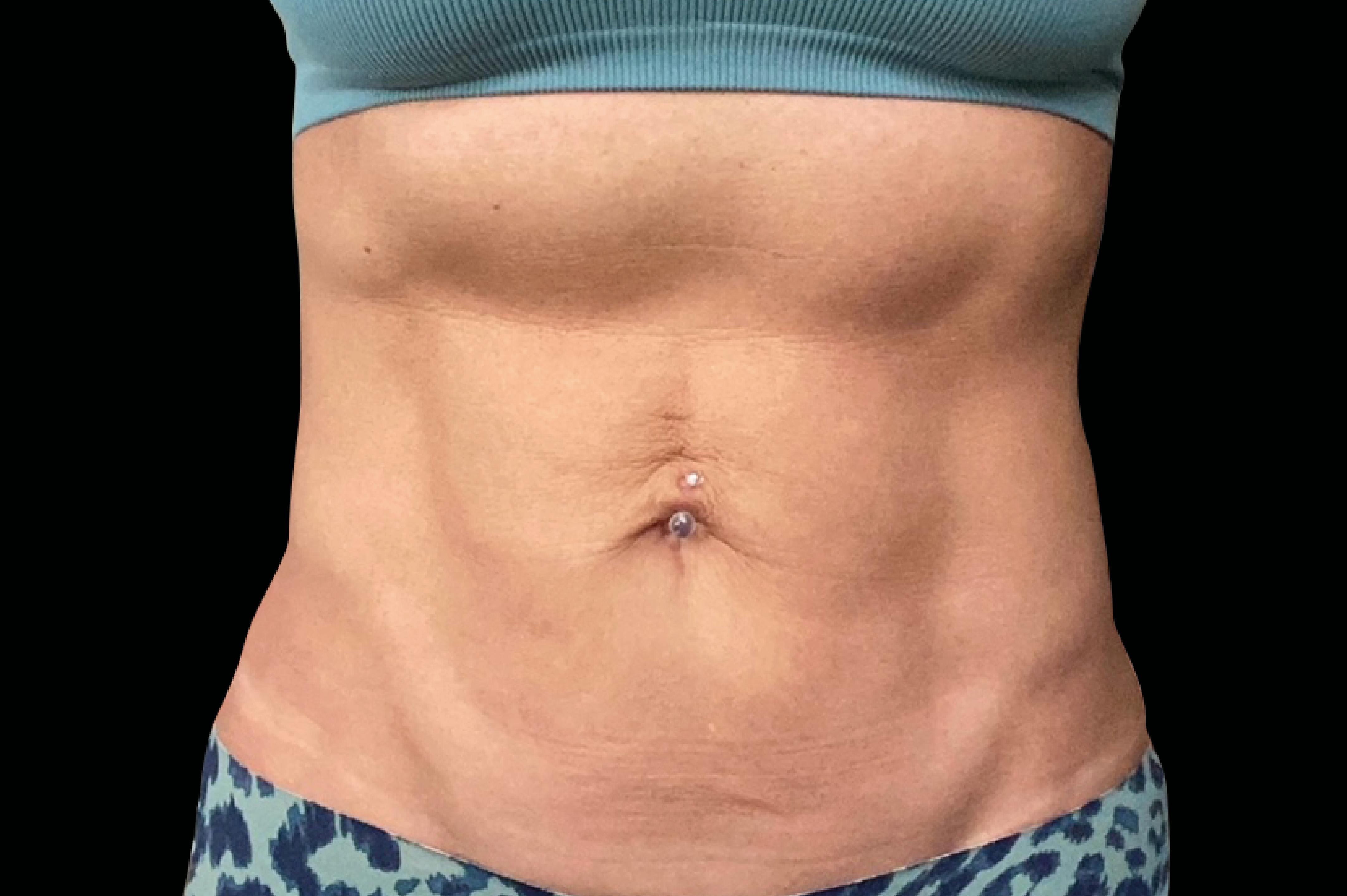 after emsculpt