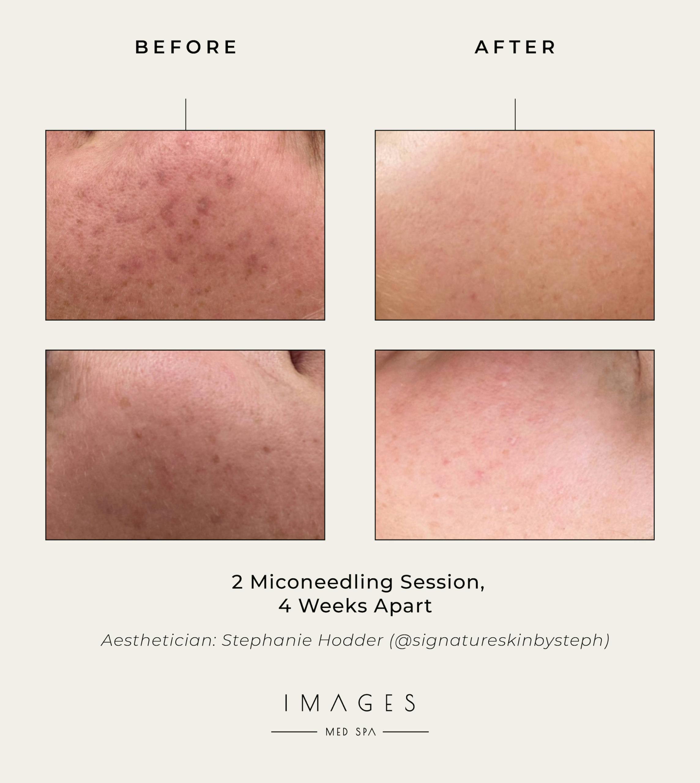 microneedling results