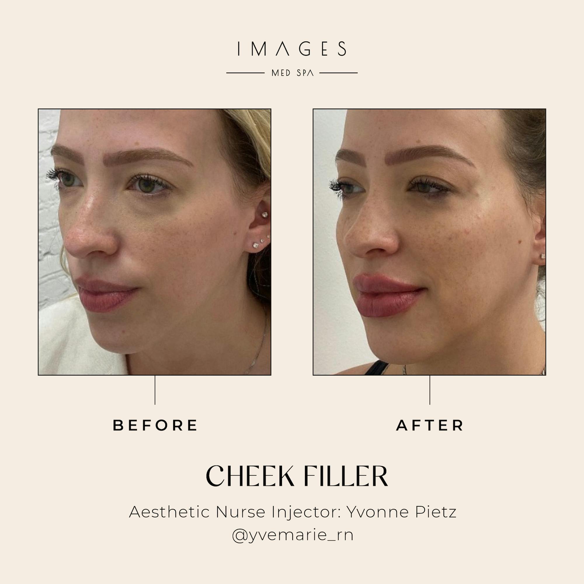 cheek filler results