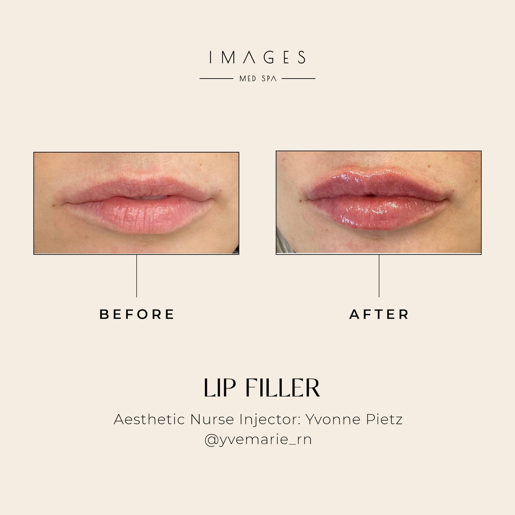 lip filler results