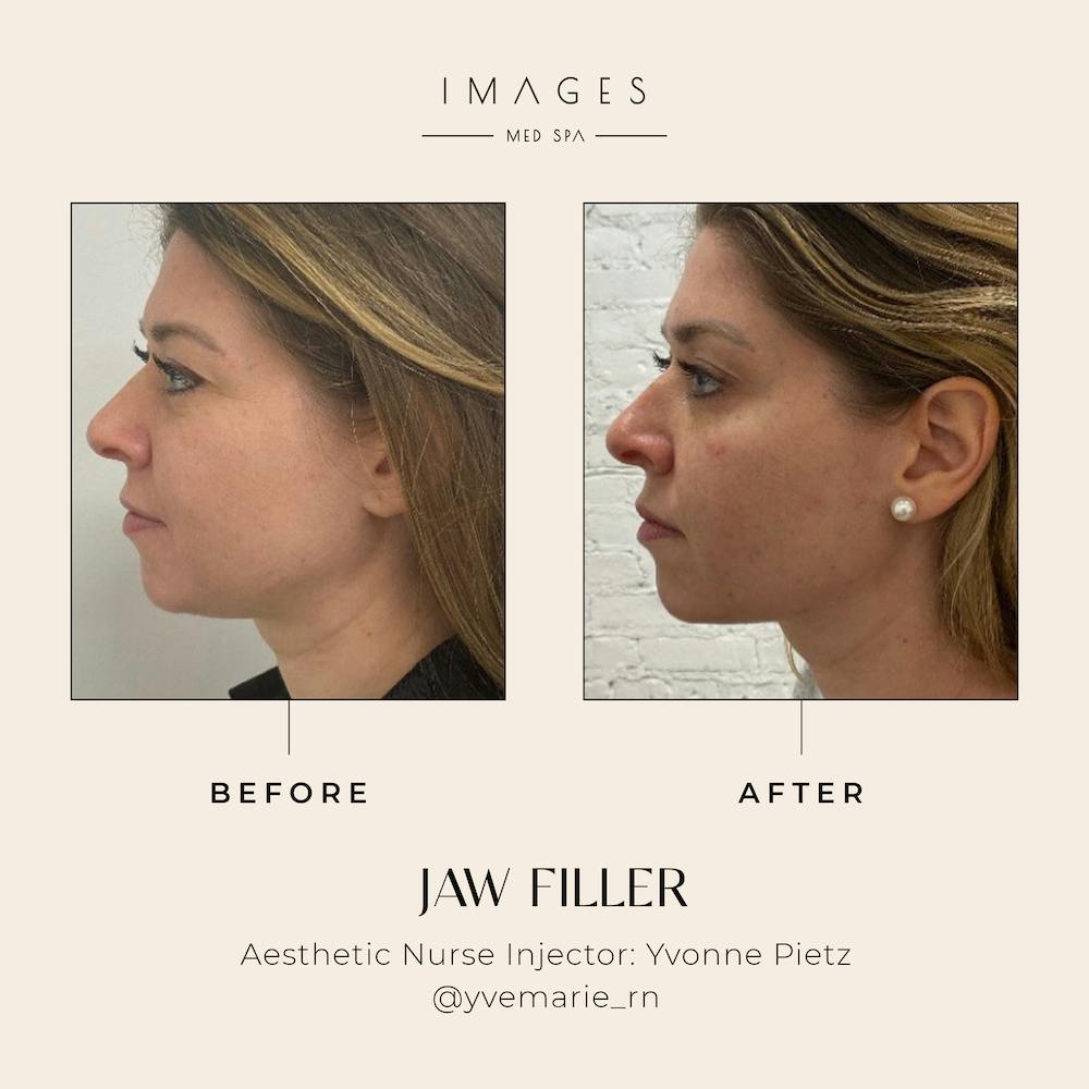 jawline filler results