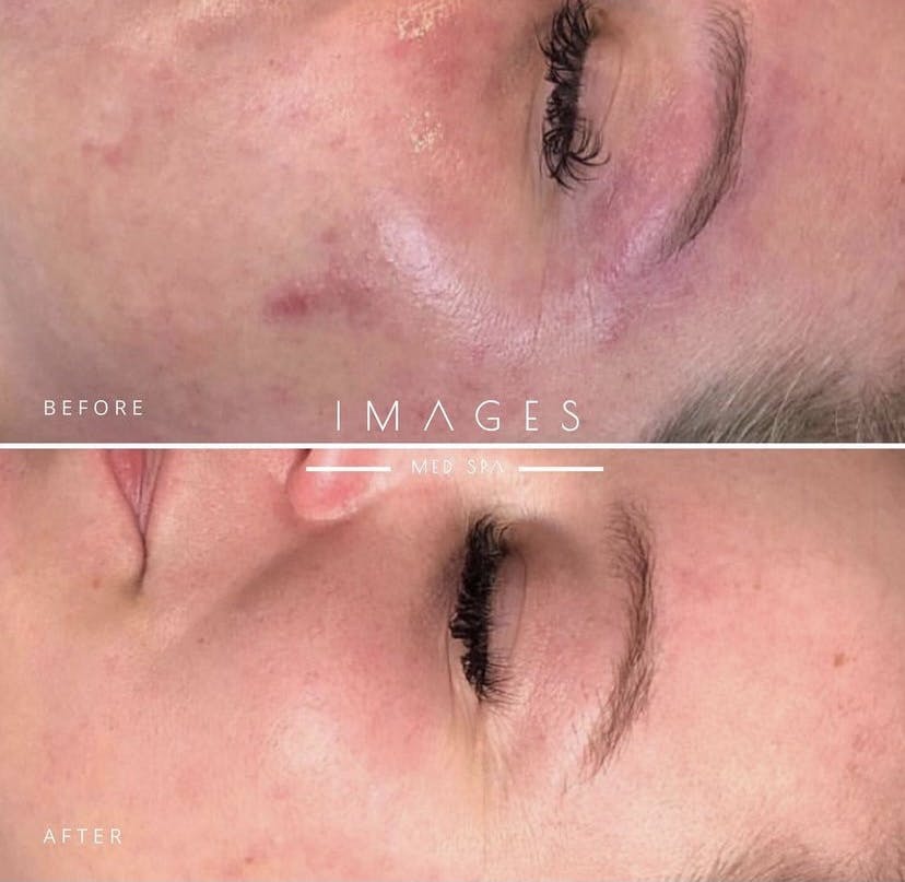 rosacea treatment results