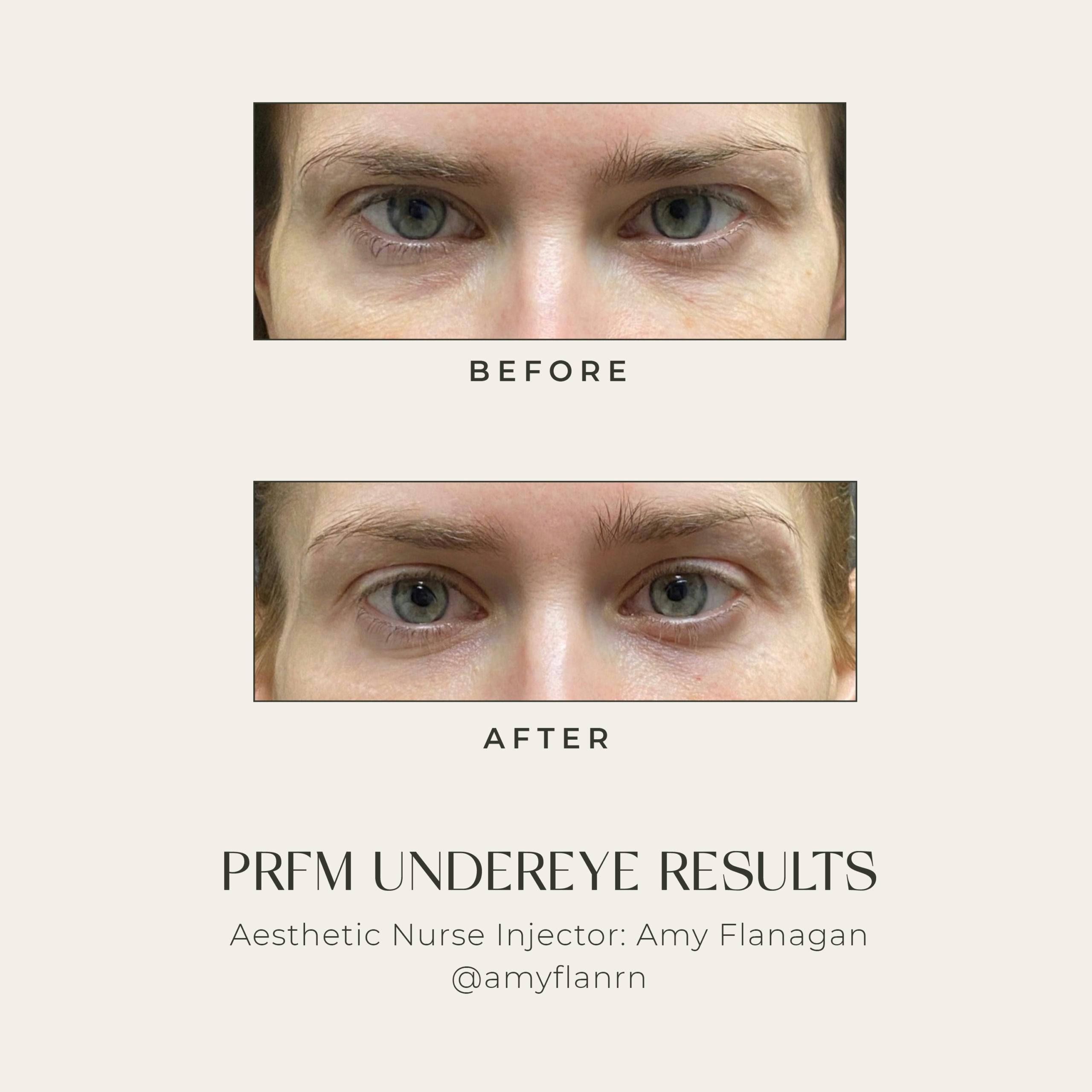 under eye treatment results