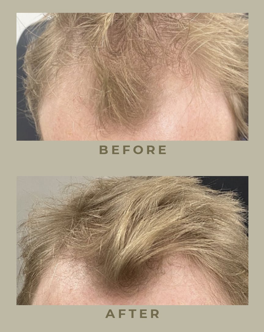 prp hair treatment results
