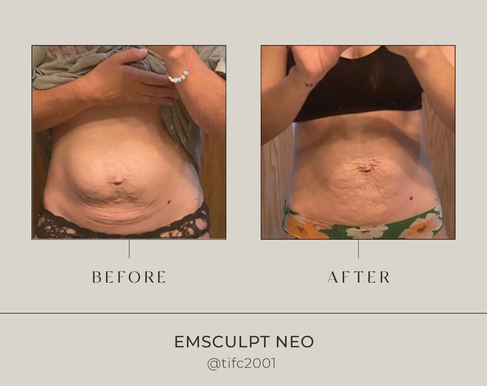 emsculpt results