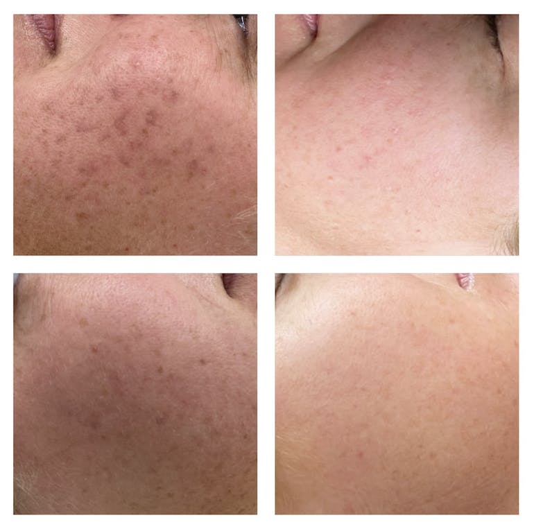 What Is Microneedling? Discover the Benefits for Radiant Skin