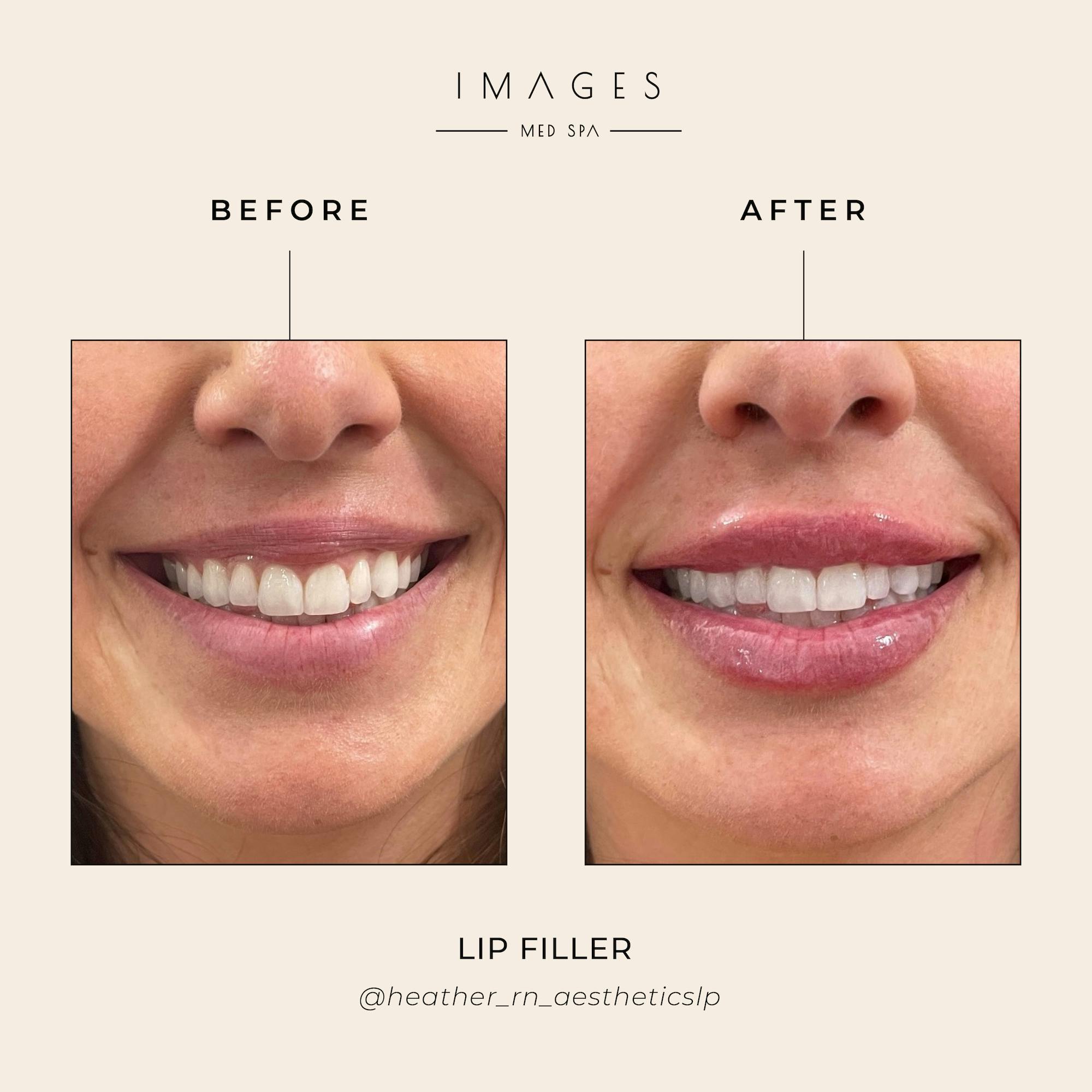 what is filler, filler before and after, dermal fillers, filler syringe, lip filler