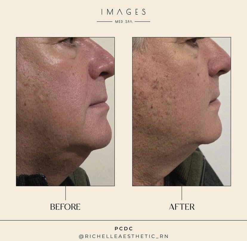 kybella, what is kybella, what is pcdc, double chin removal