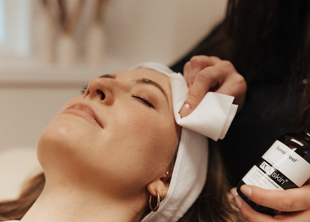 What are chemical peels, chemical peels, chemical peels for acne, chemical peels for acne scars