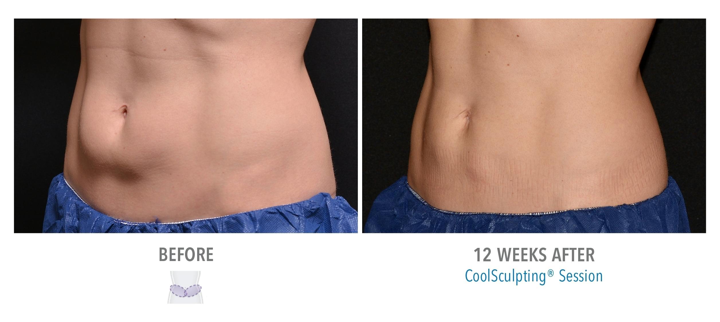 coolsculpting results