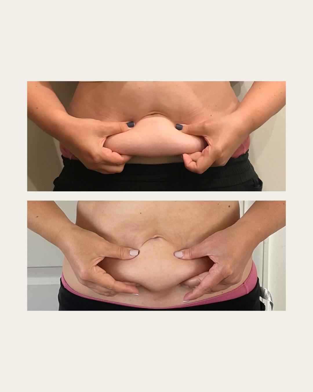 person pinching their loose skin