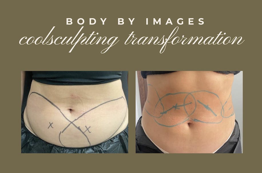 coolsculpting patient