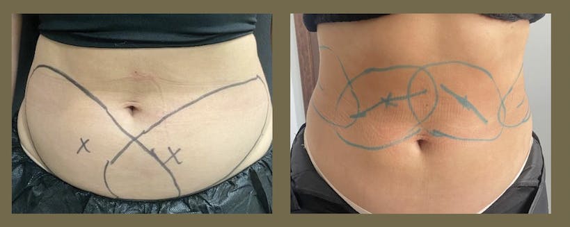 coolsculpting patient