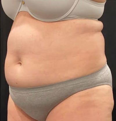 CoolSculpting Before & After Gallery - Patient 127622 - Image 2