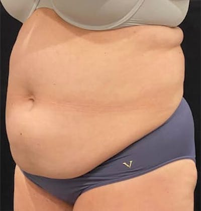 CoolSculpting Before & After Gallery - Patient 127622 - Image 1