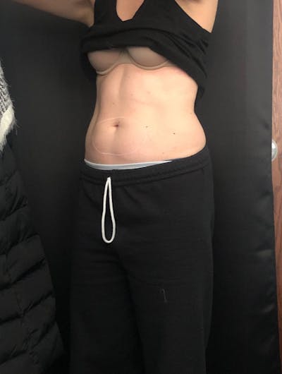 CoolSculpting Before & After Gallery - Patient 279966 - Image 2
