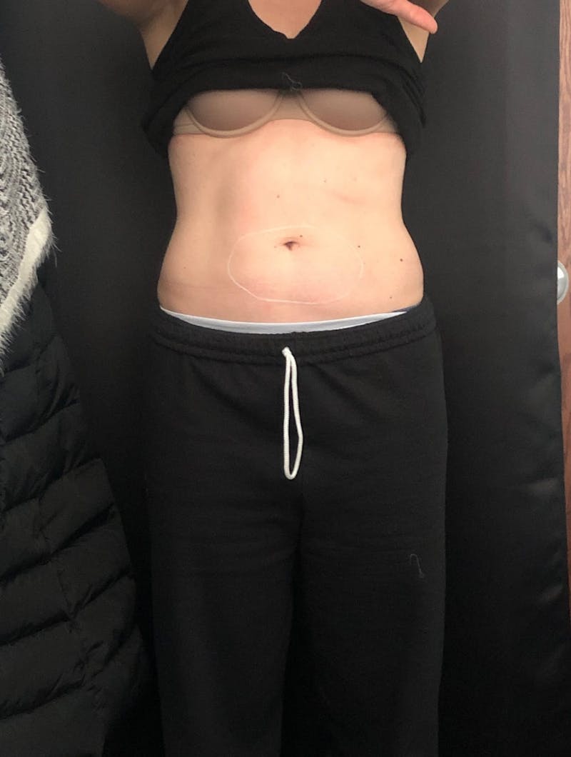 CoolSculpting Before & After Gallery - Patient 279966 - Image 6