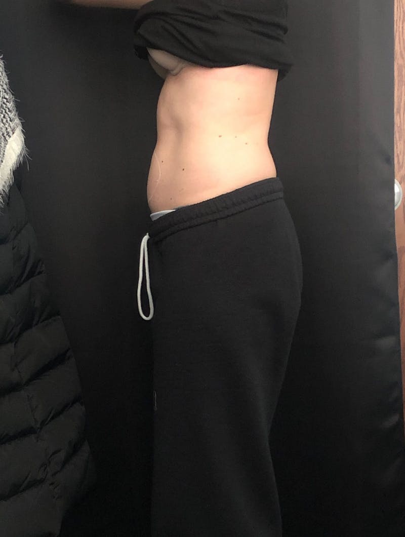 CoolSculpting Before & After Gallery - Patient 279966 - Image 8