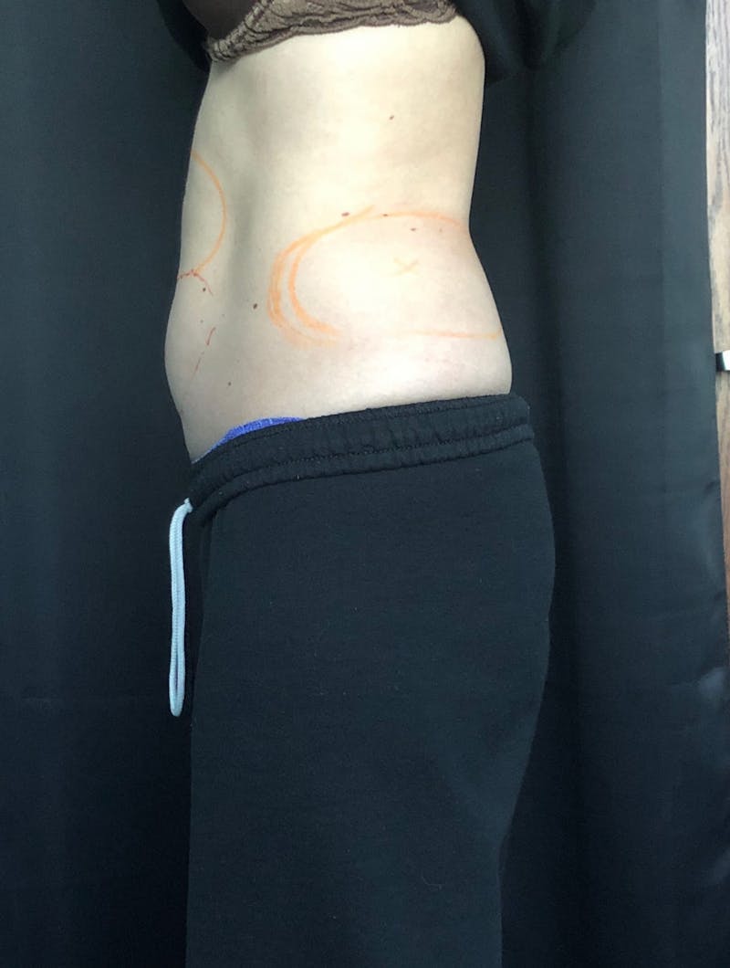 CoolSculpting Before & After Gallery - Patient 279966 - Image 7