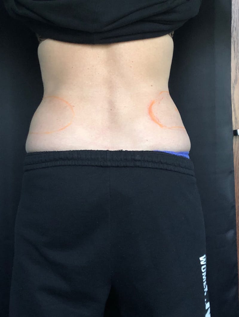 CoolSculpting Before & After Gallery - Patient 279966 - Image 3