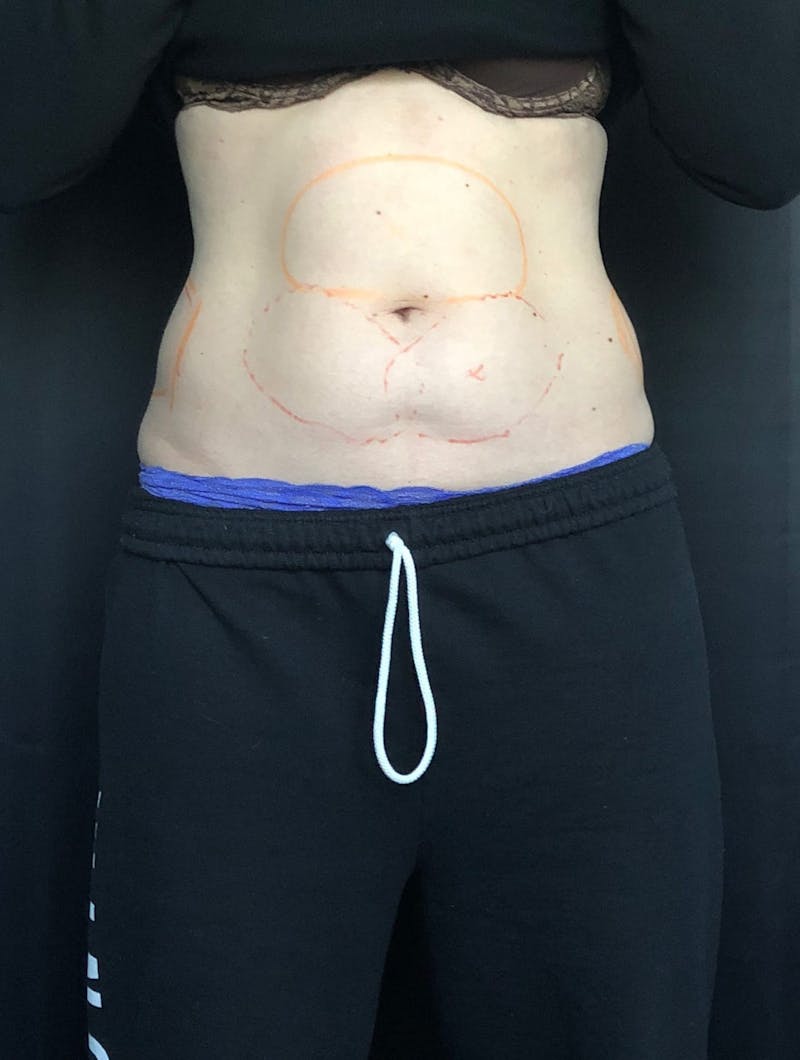 CoolSculpting Before & After Gallery - Patient 279966 - Image 5