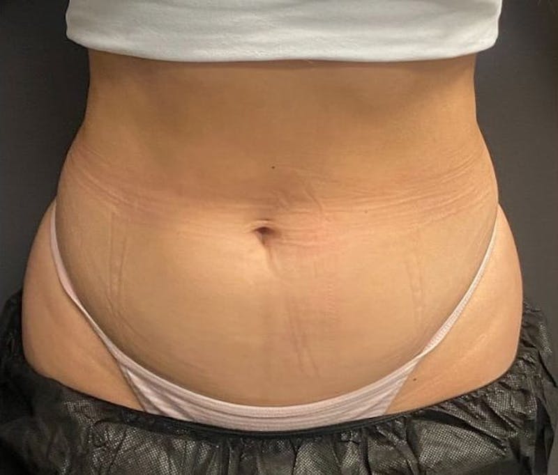 CoolSculpting Before & After Gallery - Patient 176825 - Image 6