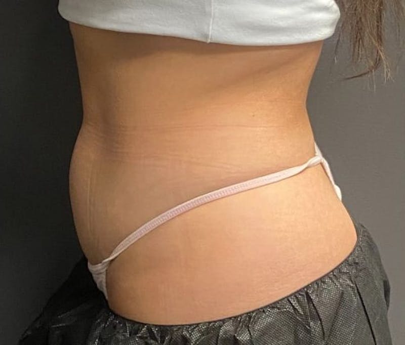 CoolSculpting Before & After Gallery - Patient 176825 - Image 3