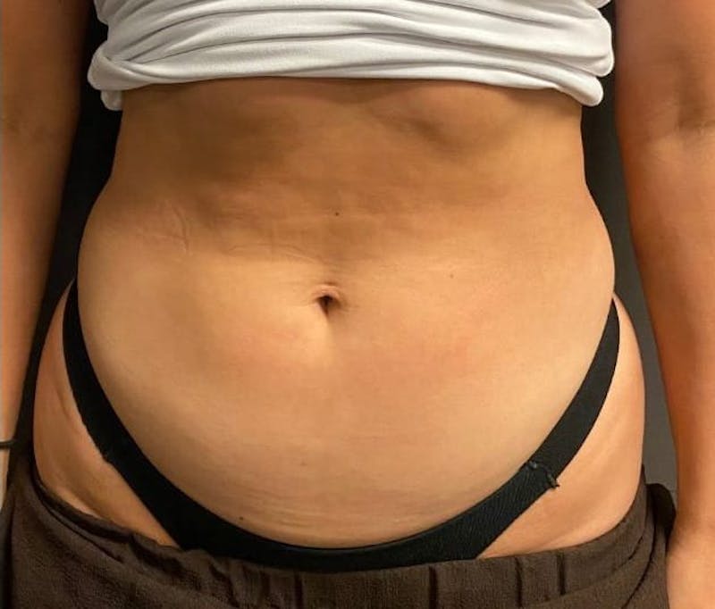 CoolSculpting Before & After Gallery - Patient 176825 - Image 5
