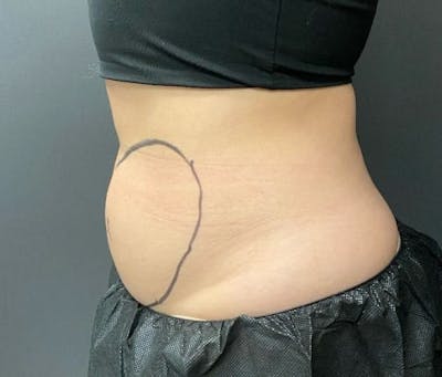 CoolSculpting Before & After Gallery - Patient 176825 - Image 1