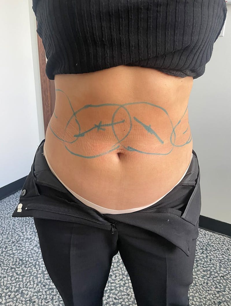 CoolSculpting Before & After Gallery - Patient 176825 - Image 8