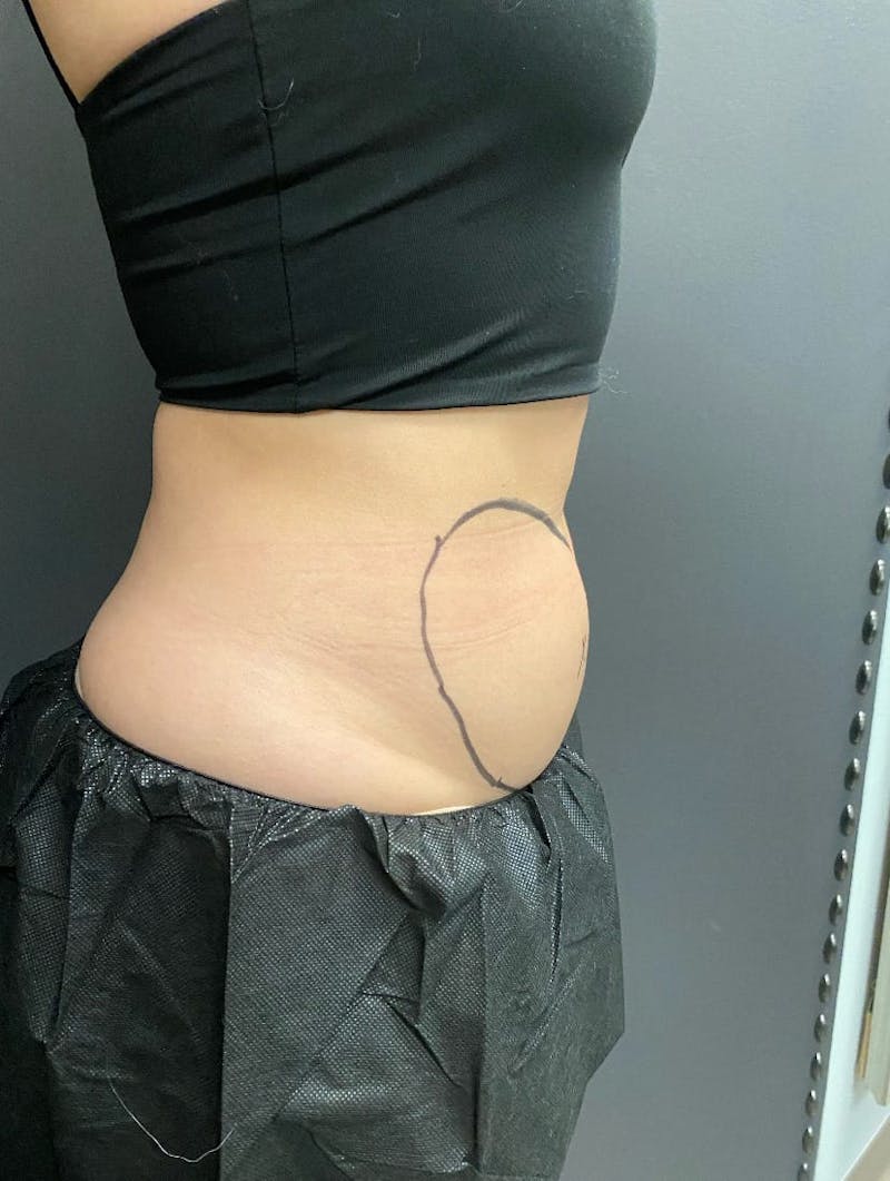 CoolSculpting Before & After Gallery - Patient 176825 - Image 10