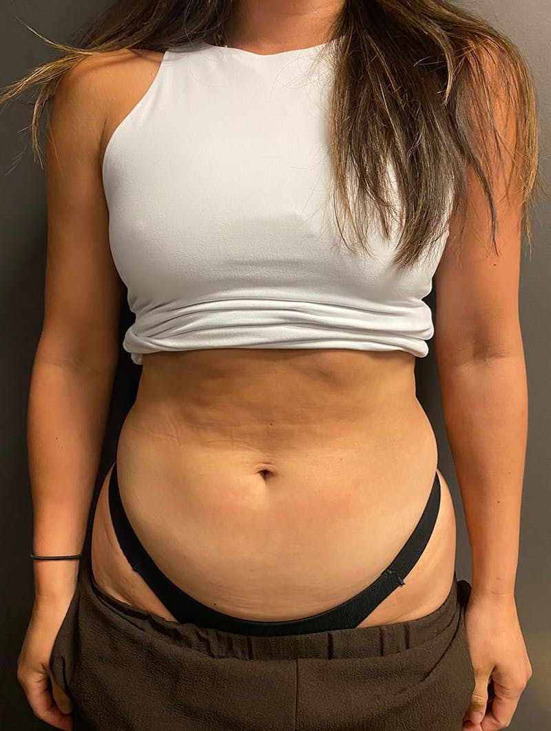 CoolSculpting Before & After Gallery - Patient 176825 - Image 9