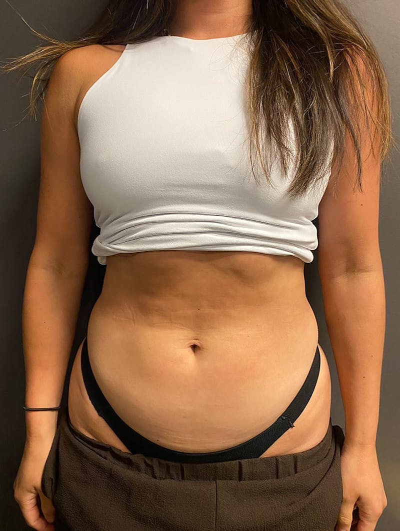 CoolSculpting Before & After Gallery - Patient 176825 - Image 13