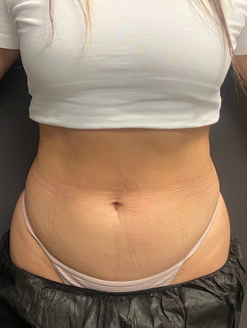 CoolSculpting Before & After Gallery - Patient 176825 - Image 14