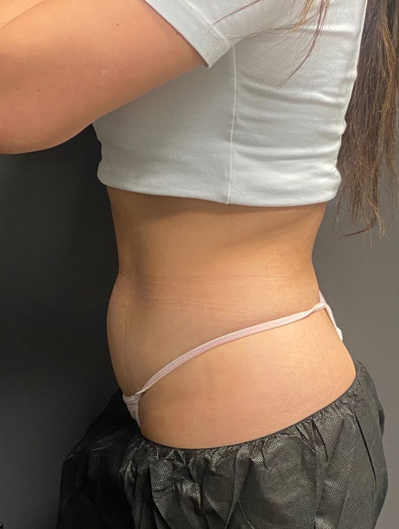 CoolSculpting Before & After Gallery - Patient 176825 - Image 15