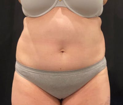 CoolSculpting Before & After Gallery - Patient 364285 - Image 2