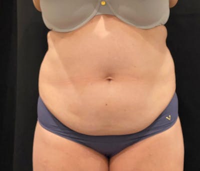 CoolSculpting Before & After Gallery - Patient 364285 - Image 1