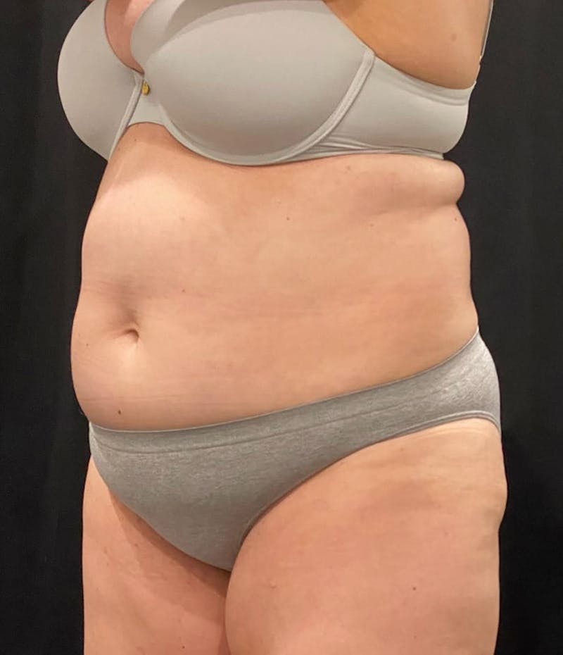 CoolSculpting Before & After Gallery - Patient 364285 - Image 4