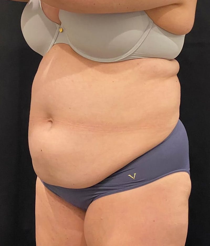 CoolSculpting Before & After Gallery - Patient 364285 - Image 3